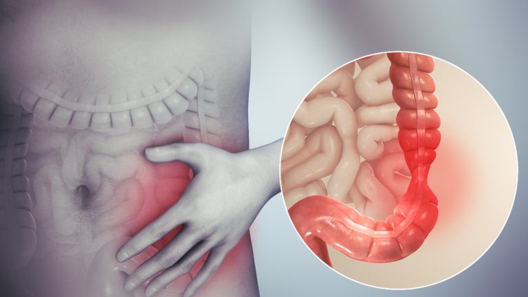 Gut disorder hidden in plain sight: Irritable Bowel Syndrome symptoms often overlooked, yet manageable with the right care